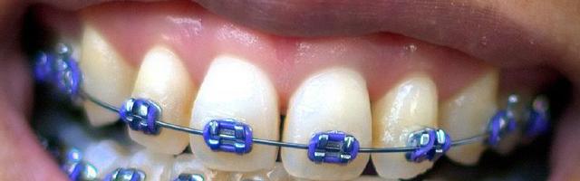 Is Adult Orthodontics Right For You?