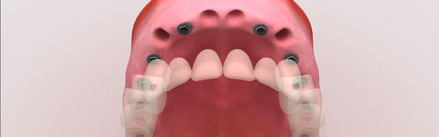 Dental implant supported dentures