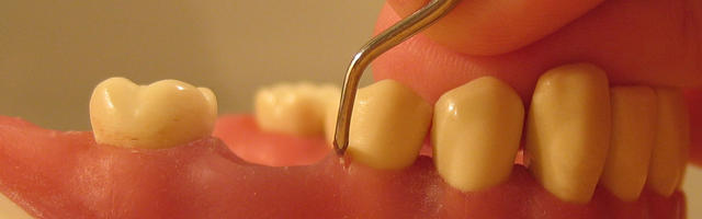 Gum Recession With Dental Implants