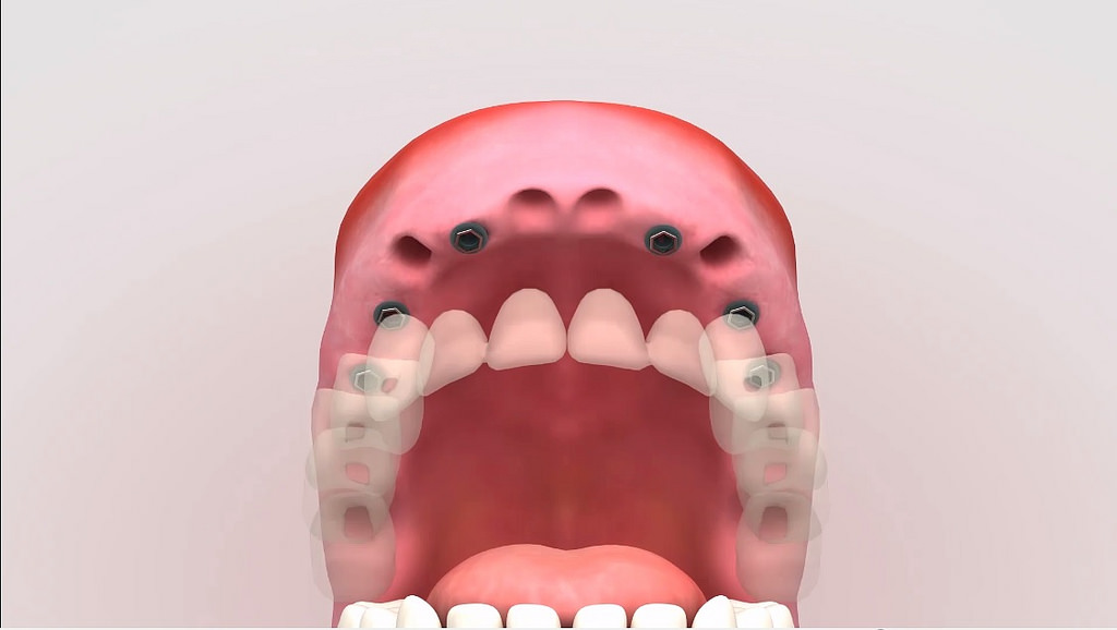 Denture