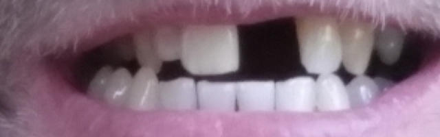The Cost of NOT Replacing Missing Teeth