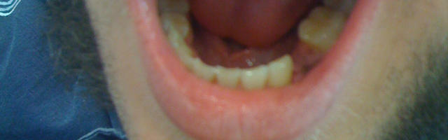 Why It’s Important To Replace Teeth