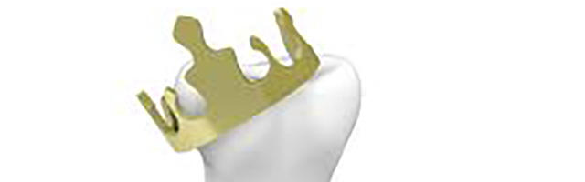 Getting Crowns Abroad