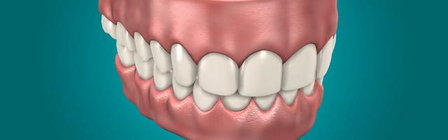 Dental implant supported overdentures