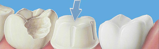 Everything about Crowns