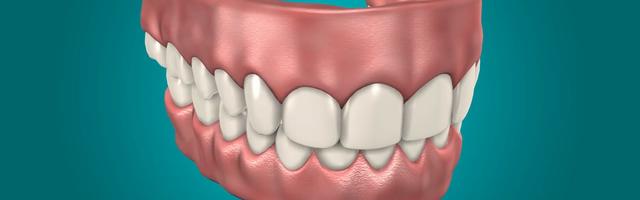 Dental Implants Versus Dentures: Which to Choose and Why?