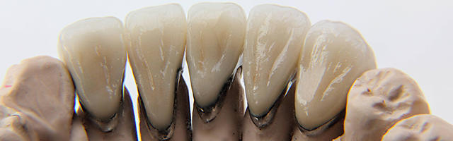 Crown popped off? Do NOT attempt to re-adhere it!