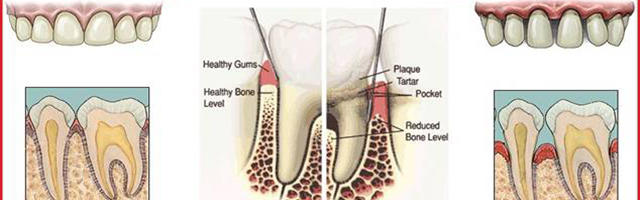 The Link Between Periodontitis and Osteoporosis
