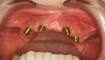 implant denture