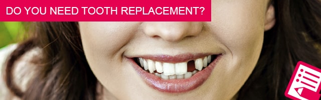 Do you need tooth replacement?