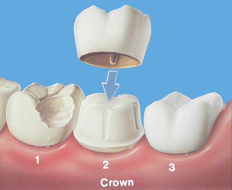 dental crowns