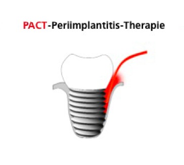 Peri-implantitis