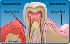 Gum Disease